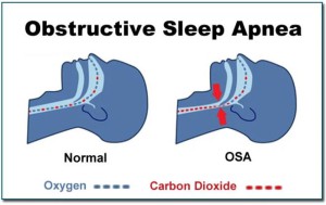 Figuur 3-  Apneus  zijn een  onderbreking  van de ademhaling, terwijl &quot; hypopnoes &quot; een  vermindering van de ademhaling zijn. Obstructieve slaapapneu is het gevolg van een blokkade. Bij centrale slaapapneu is er geen blokkade; de hersenen geven het ademhalingssysteem geen signaal om te ademen.