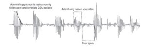 Cosinusvormige ademhalingspatroon tijdens OSA periode