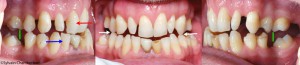 ClPe-effets-secondaires-orthese-davancee-mandibulaire-orthodontiste-chamberland-Quebec.jpg